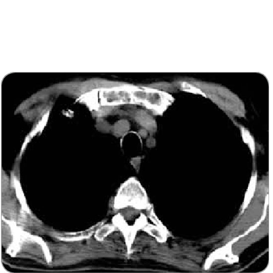 MRI Screening of Sternum